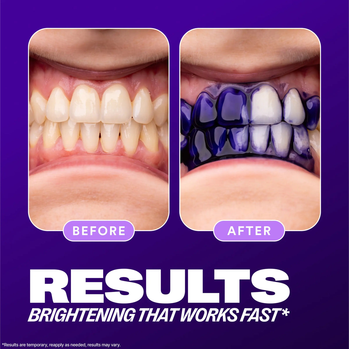 V34 Colour Corrector - Tooth Stain Concealer, Purple Whitening